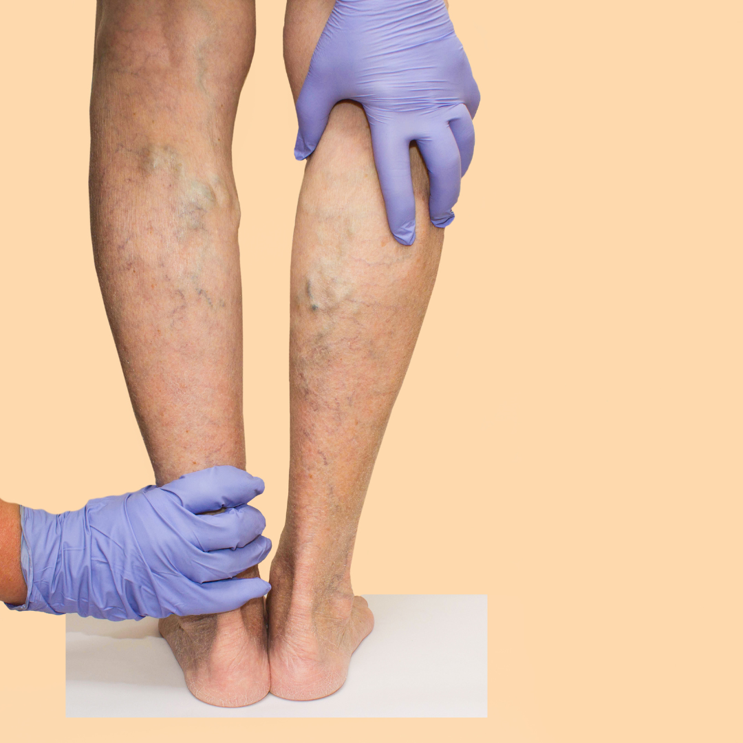 Effective Strategies for Treating Varicose Veins